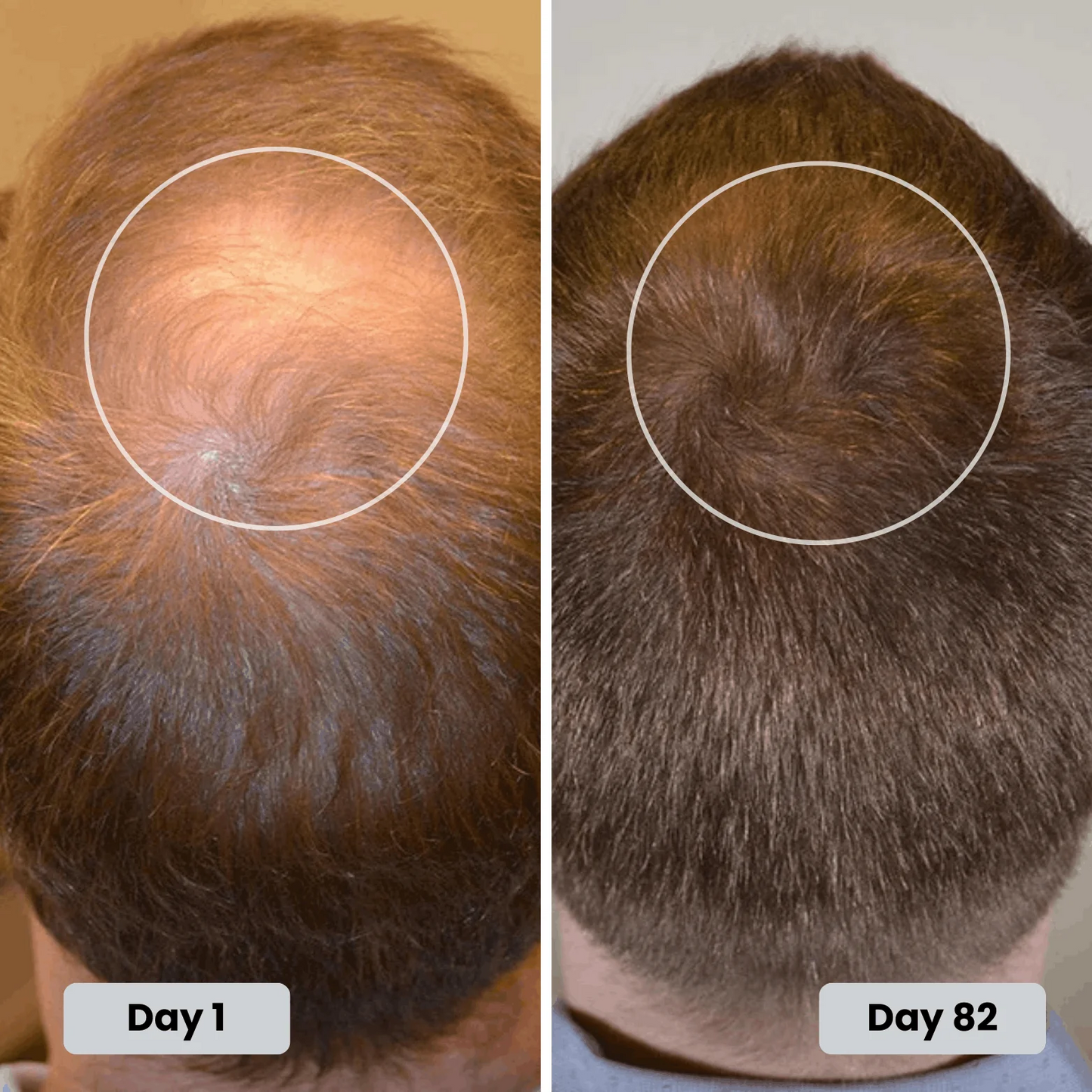 Red Light Therapy Cap for Hair Regrowth Treatments